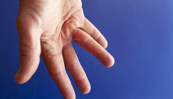 Dupuytren’s Contracture – Causes, Symptoms, and Home Remedies
