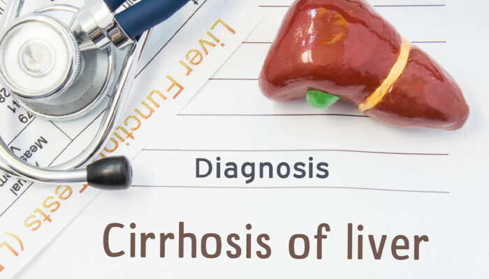 Liver Cirrhosis – Its Stages and Prevention