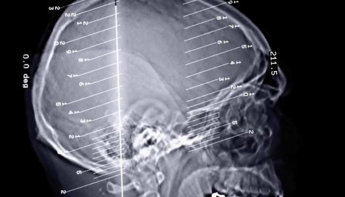 Complication and lifestyle disorders caused by epilepsy