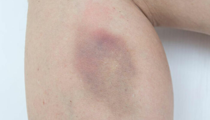 Easy bruising – Causes and treatments
