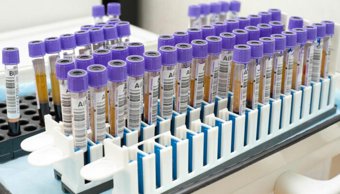 Here’s what you must know about age-specific PSA levels