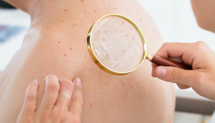 Important things about staph infections you need to be aware of