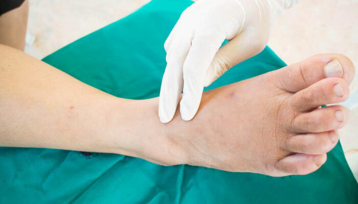 Neuropathy – An Overview