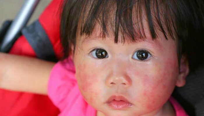 Skin Rashes – Common Types and Causes