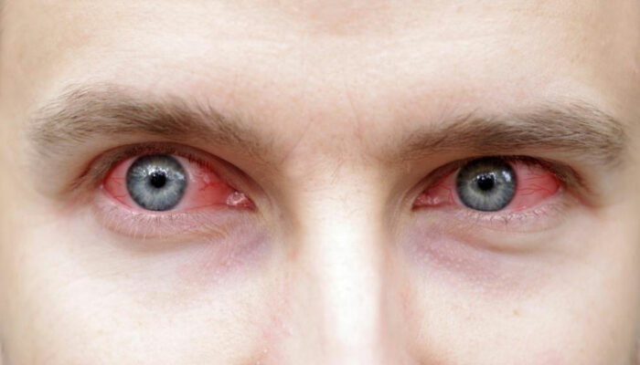 Tips to control the symptoms of Sjogren’s syndrome effectively