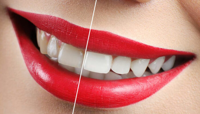 Yellow Teeth – How to avoid discoloration of teeth