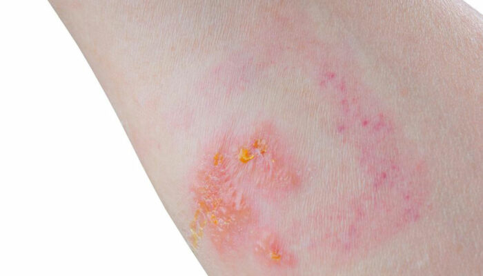 6 Home Remedies for Treating Skin Rashes