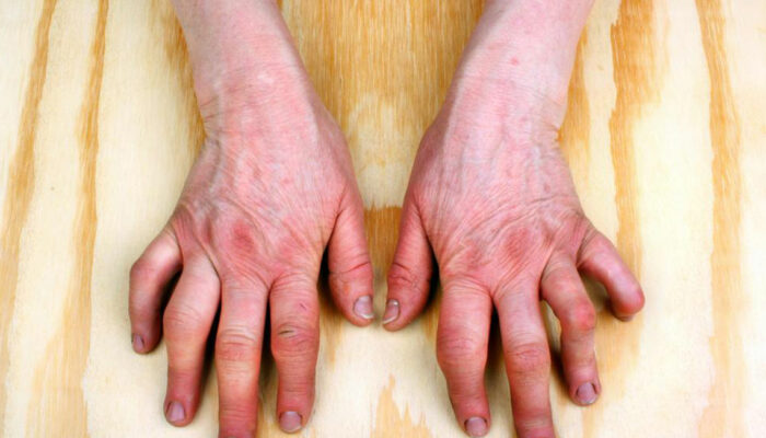A Brief Overview of Rheumatoid Arthritis