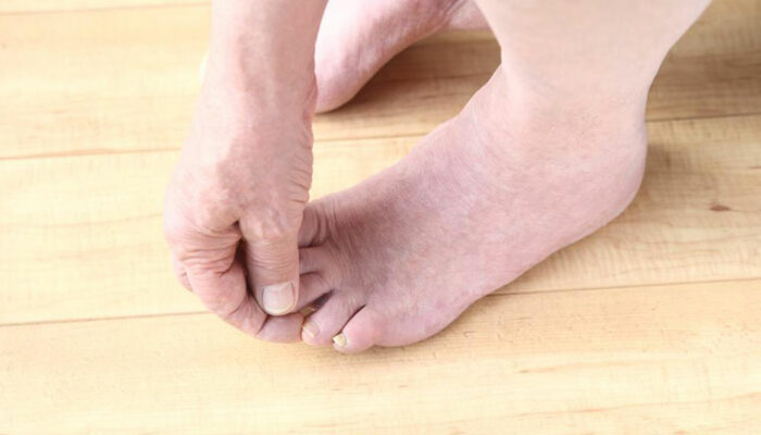 Diabetic Neuropathy – Risk Factors, Symptoms, and Treatments