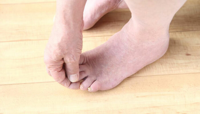 Fibromyalgia Foot Pain – Factors to Understand