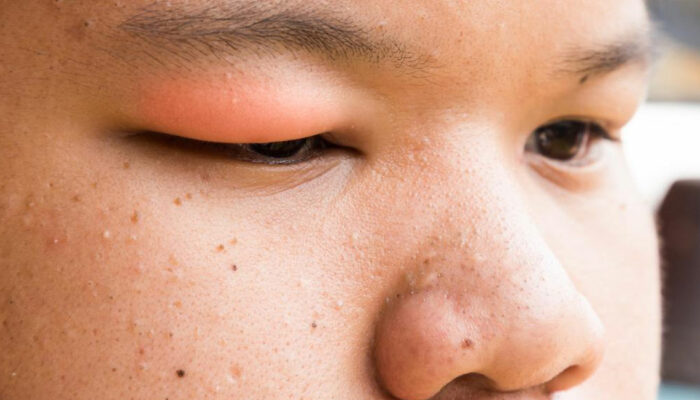 Here’s How to Get Rid of a Stye With These Simple Steps