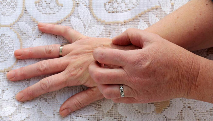 Here’s how you can identify and prevent scabies skin rash