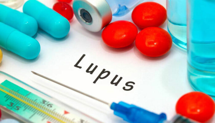 Lupus – An Overview