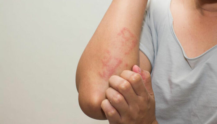 Lupus Skin Rash – Symptoms and Treatment