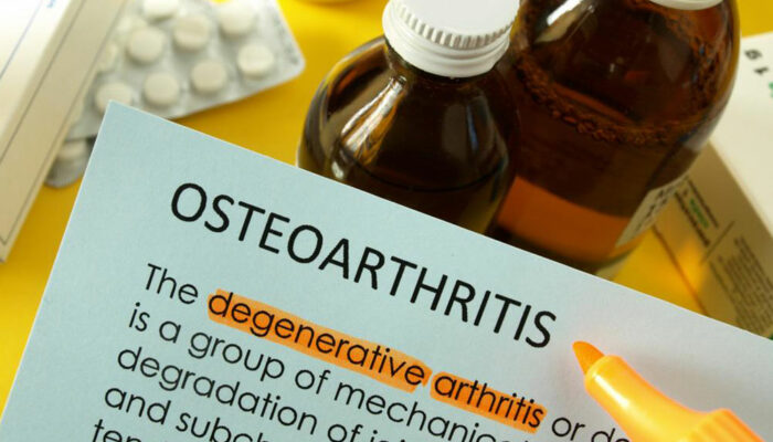 Osteoarthritis – How to Treat it