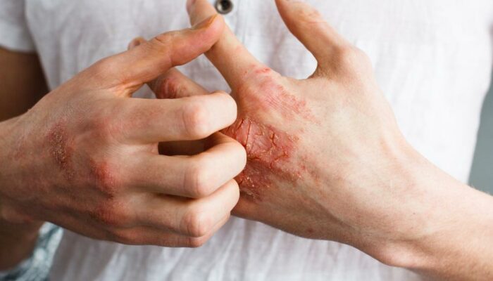 Treatment methods for eczema