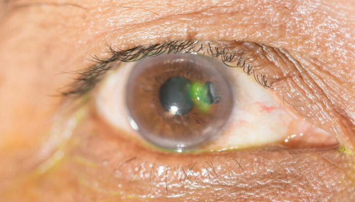 Various eye diseases and their symptoms