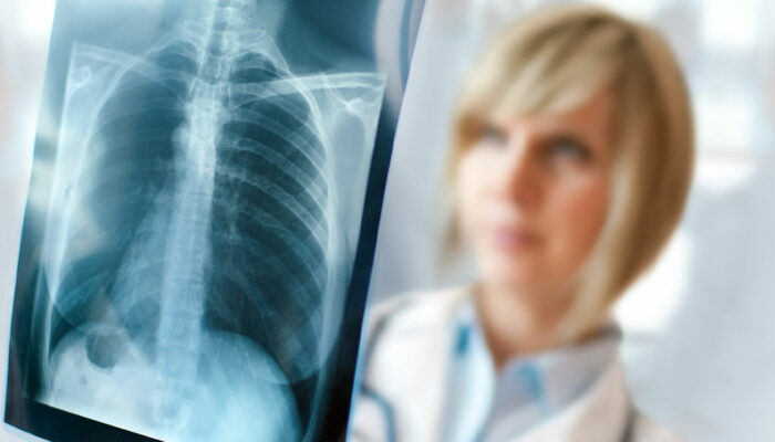 Signs, Symptoms And Treatment Options For Lung Cancer