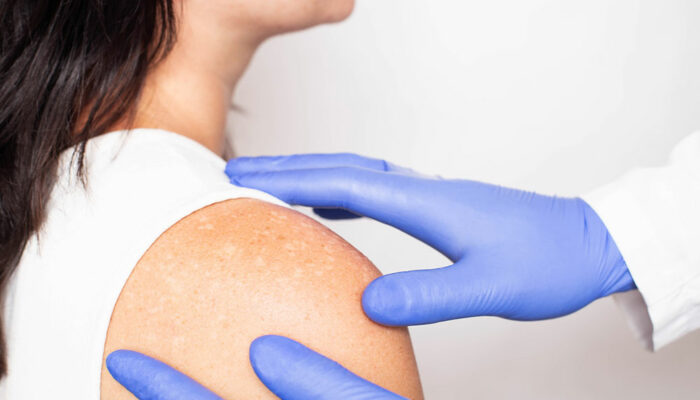 Vitiligo – Signs, Causes, and Management Remedies