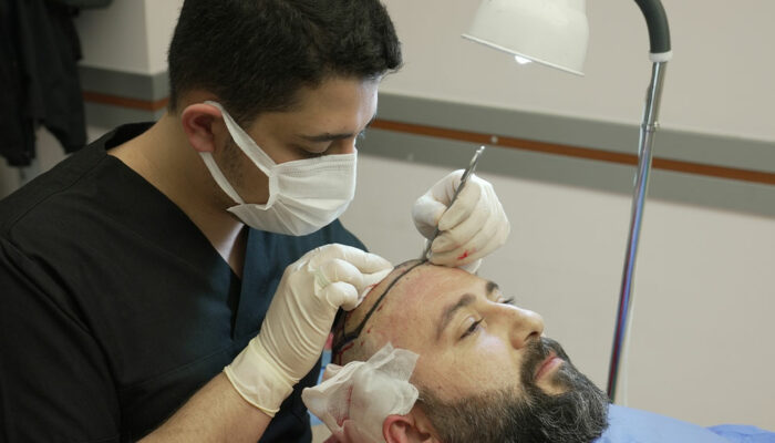Everything to Know About a Hair Transplant in Turkey